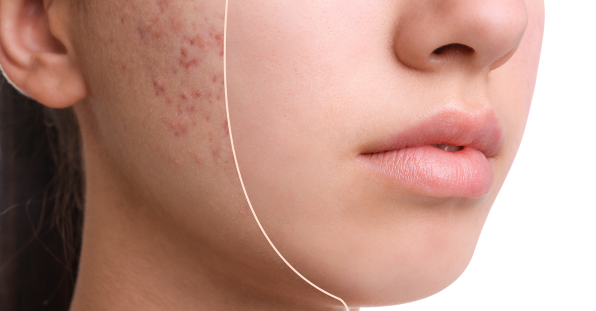 viso di donna con e senza acne