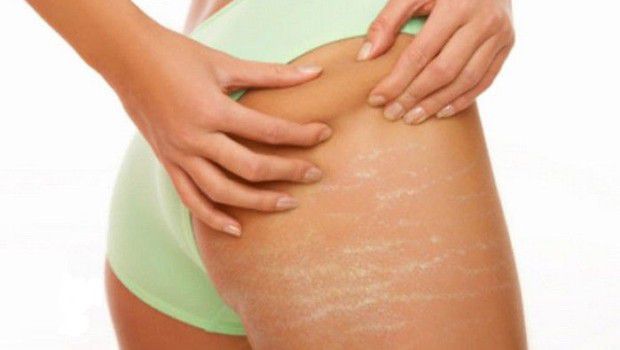 Rimedi per le smagliature per una donna