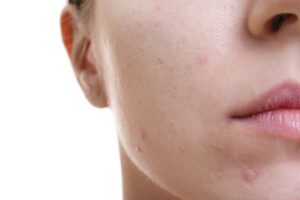 viso di donna con un dei punti di acne